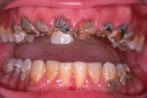 Dåliga tänder 2