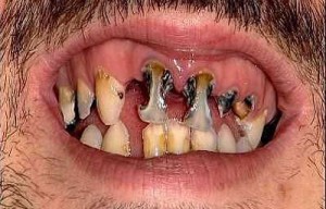 Dåliga tänder 3