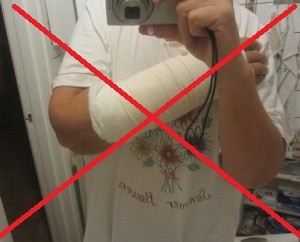 Gipsad arm